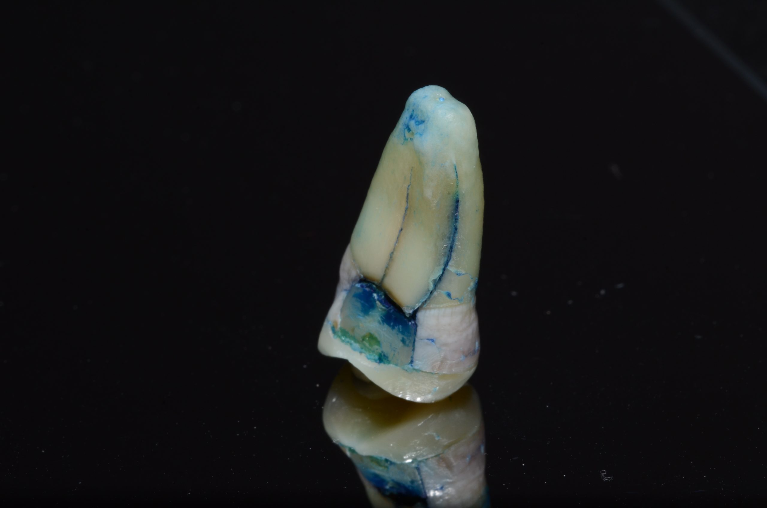 Dientes Fisurados