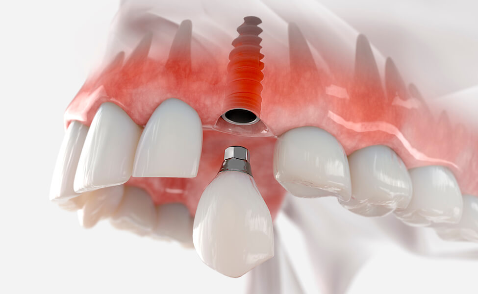 Fracaso de implantes dentales: causas y tratamiento